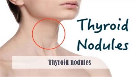 Symptoms of hyperthyroidism may be vague and easy to dismiss. . Thyroid nodule reddit